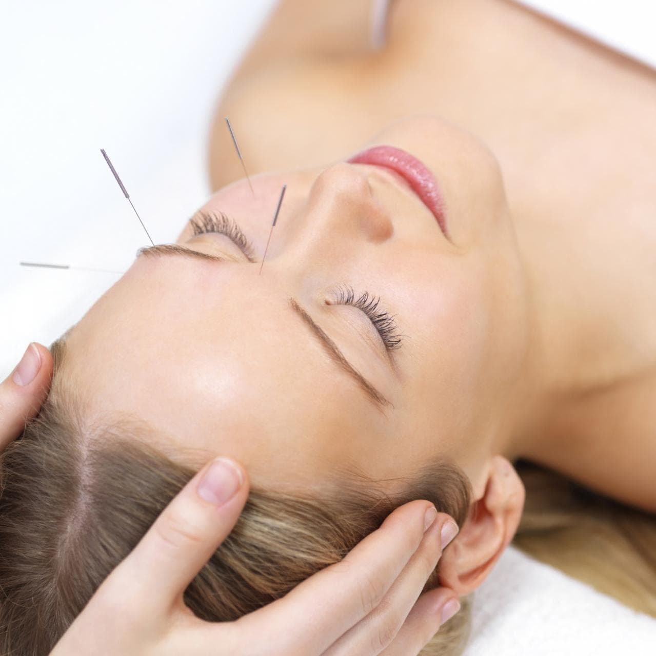 Acupuncture